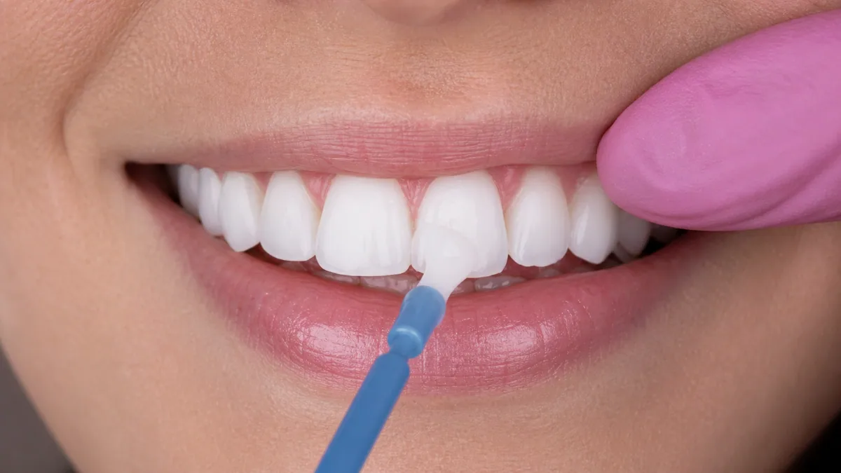 Fluoride Treatment in North York | Enamel Strengthening & Cavity Prevention Fluoride treatment in North York being applied to a patient's front teeth with a varnish applicator brush.