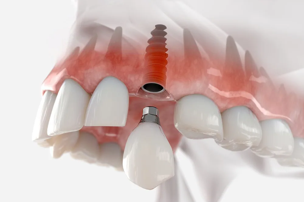 Dental Implants in North York | North Toronto Dental Centre 3D illustration of a single-tooth dental implant being placed in the upper jaw at a North York dental clinic
