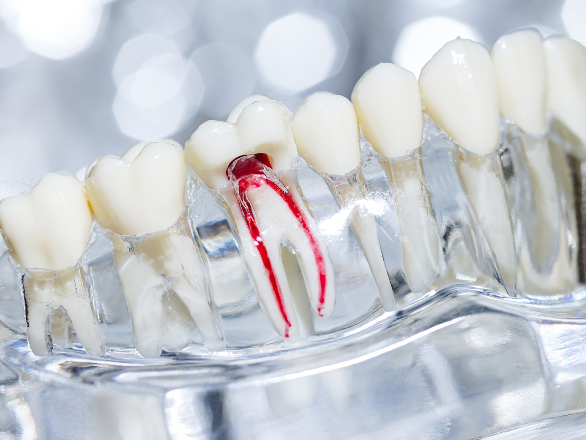 Emergency dentist on Avenue Road treating root canal crisis North Toronto Dental Centre